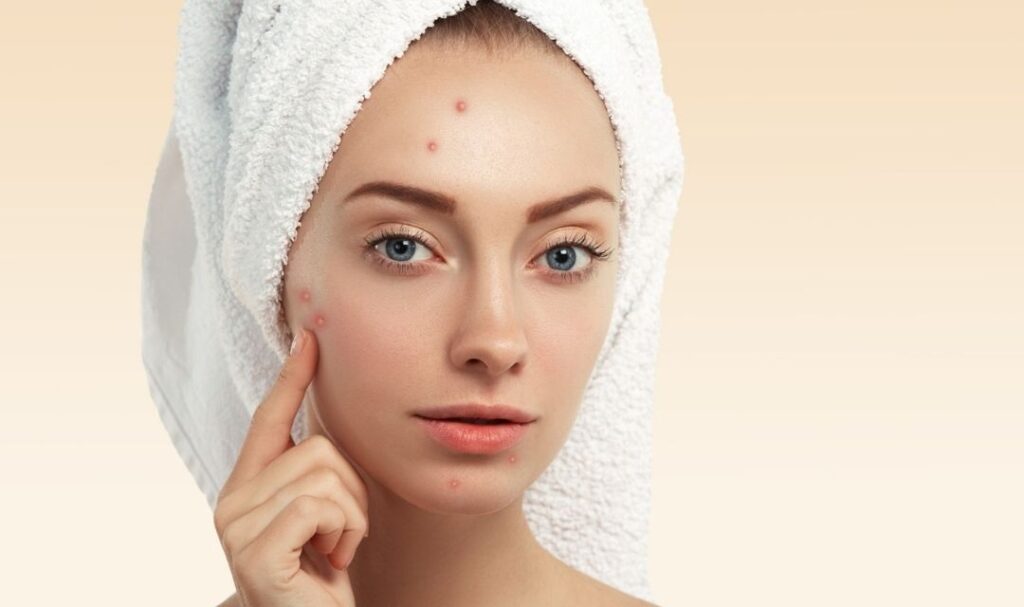 Acne treatment in Noida