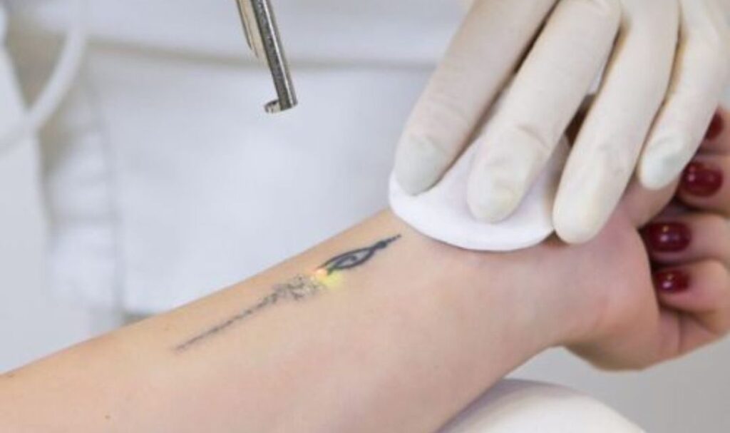 Tattoo Removal in Noida