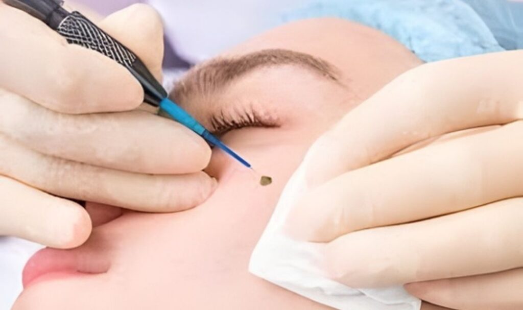 mole removal in Noida